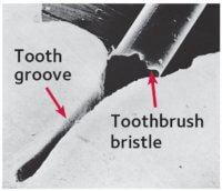 Even a toothbrush bristle is too big to reach inside a groove in the tooth (magnified).